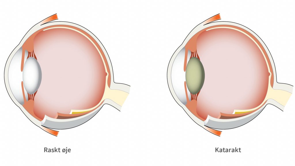 Katarakt eller grå stær gør linsen uklar og grumset.