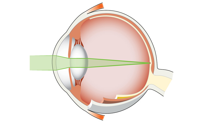 Ved normalt syn brydes lysstrålerne på et punkt på nethinden.